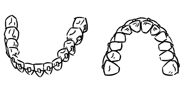 Zahnspangen Zahnspangen